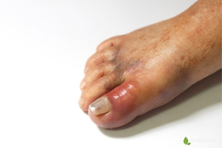 gout