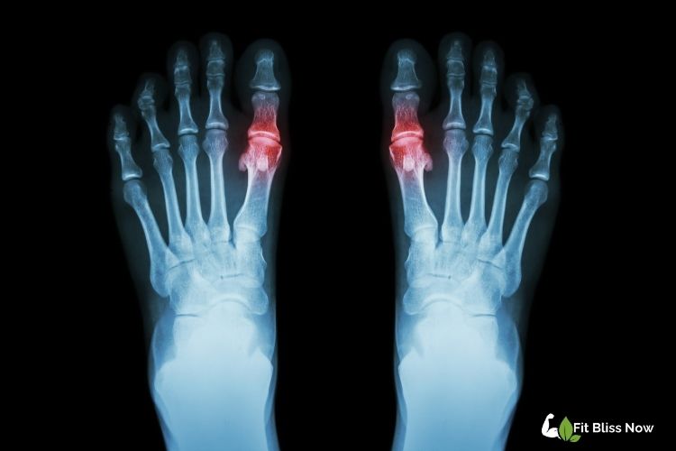 What is Gout?